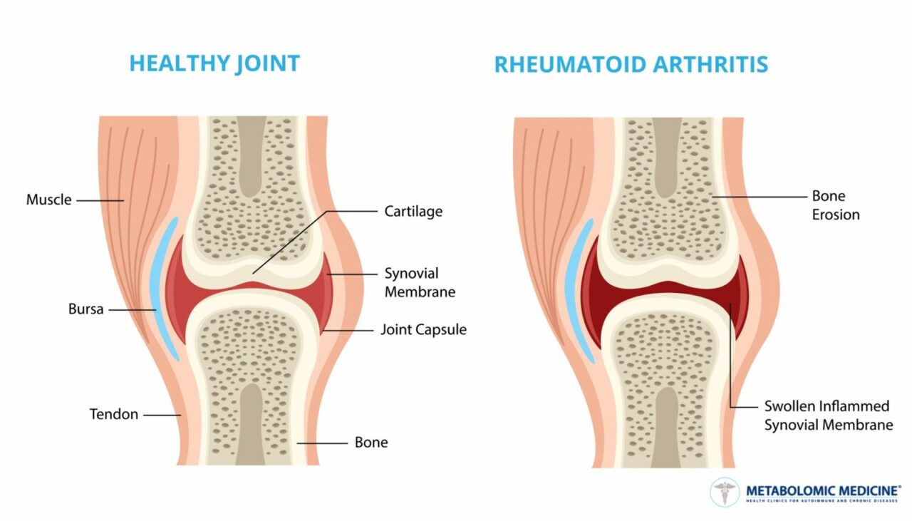 Is Arthritis Just Wear And Tear Or An Old Person Disease Dr Peter 